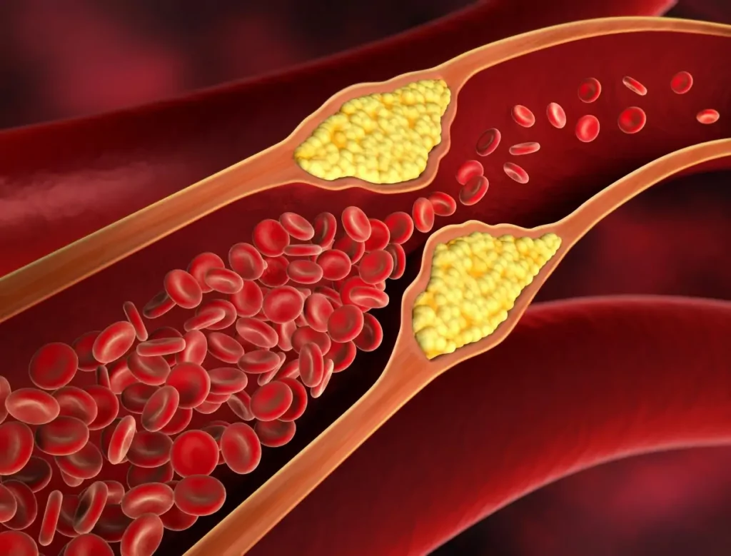 Artist depiction of atherosclerosis | cholesterol reduction strategies